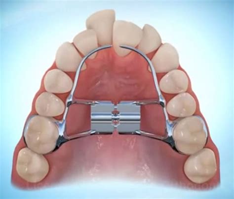 What to Expect With Your Child's Orthodontic Expander | Jorgensen Orthodontics - Affordable Care