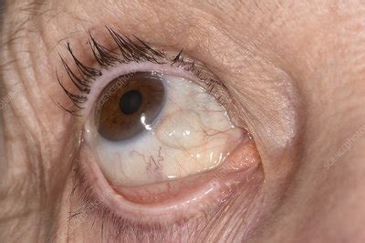 Conjunctival cyst - Stock Image - C047/2967 - Science Photo Library