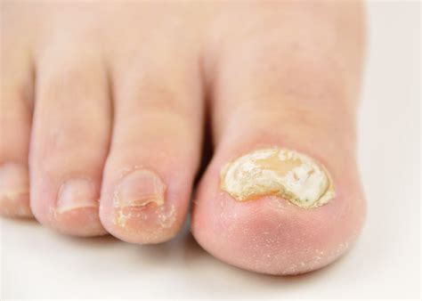 Apple Cider Vinegar for Toenail Fungus (2023) - Best Guide