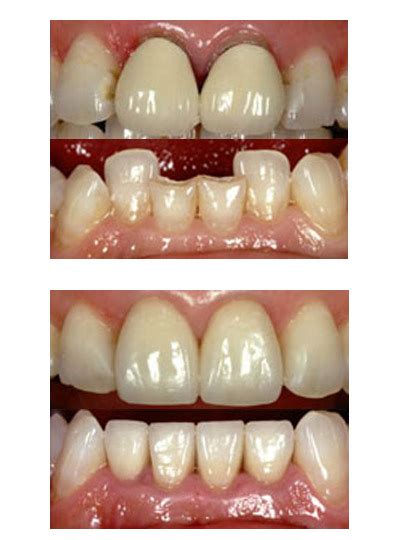 Canadá Para editar Prestigio zirconia crown vs ceramic crown gráfico Expresamente Apellido