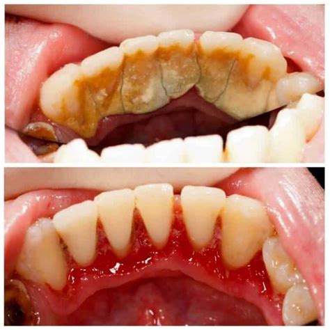 Teeth Cleaning Before and After - Teeth FAQ Blog