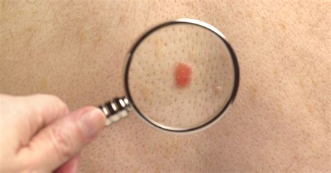 Nodular Melanoma: Symptoms of This Aggressive Cancer