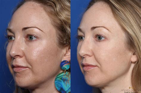 Refresh Your Skin: The Best Laser Skin Resurfacing Treatments – Dr. Camp
