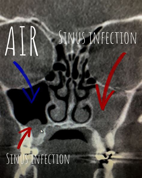 Sinus pressure or pain? It may not be a sinus infection.