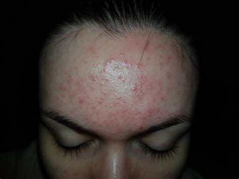 Red irritating bumps mainly on forehead. PLEASE HELP ME! With photo - Adult acne - Acne.org