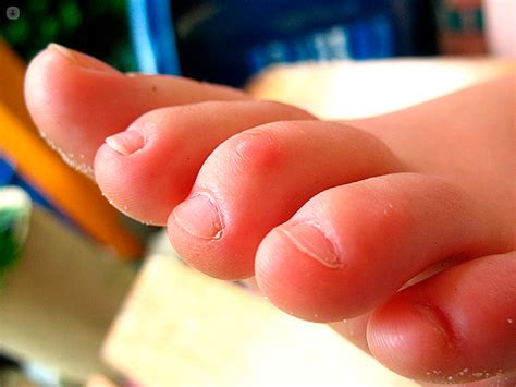 Claw Toe : Cause, Symptom's, Diagnosis, Physiotherapy Treatment