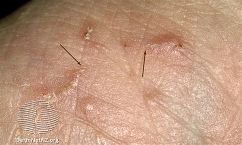 How to recognize a scabies rash with pictures – Artofit