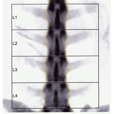 DEXA scan of the lumbar spine (L3-L6) using GE Lunar Prodigy DPX X-Ray ...