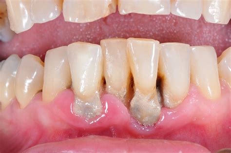 What Is The Main Cause Of Gum Disease?