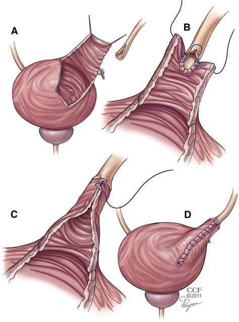 Robotic-assisted laparoscopic surgery: recent advances in urology - Fertility and Sterility