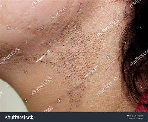 Nevus comedonicus : 2 images, photos et images vectorielles de stock | Shutterstock