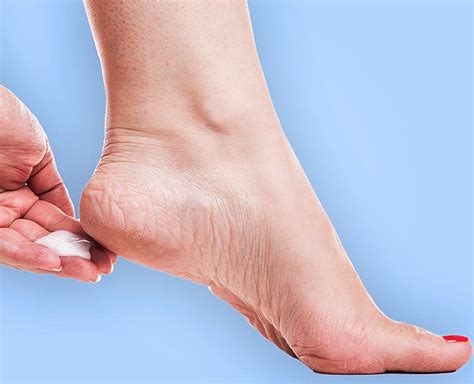 Have Cracked Heels? These 9 Home Remedies Will Solve Your Problem ...