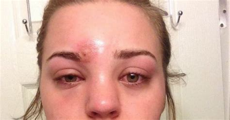 Pimple staph infection: Katie thought it was a pimple. It wasn't.