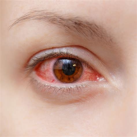 Dry Eye vs. Eye Allergies - Monterey, CA - Salinas - King City
