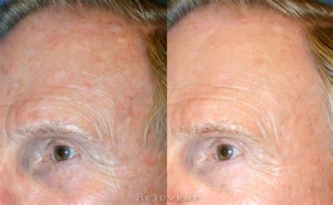 Levulan PDT (Photo Dynamic Therapy) • Rejuvent Medical Spa Scottsdale