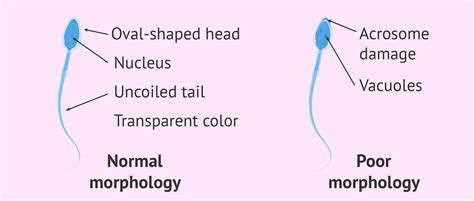 Characteristics of normal sperm morphology