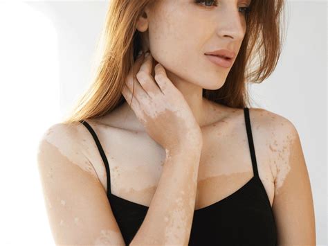 Vitiligo Causes, Treatments, and General Skin Care - Dr. Praneeth Clinic