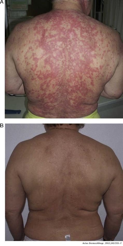 Refractory Subacute Cutaneous Lupus Erythematosus Treated With Rituximab | Actas Dermo ...