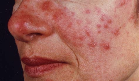 Acne Rosacea Vs Acne Vulgaris