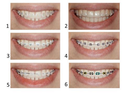 Types Of Braces- Pros And Cons Of Different Types Of Braces