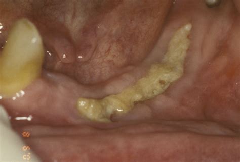 Jaw Osteonecrosis