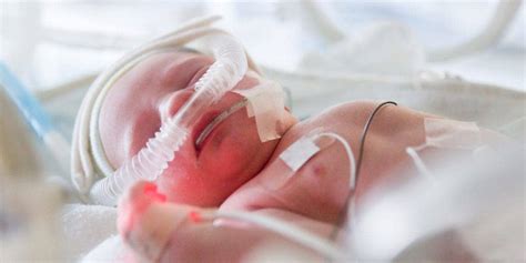 One-time Preemie Now a Neonatal Physician Treating Infants with Ventilation | RT