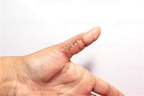 Close-up of a hand wound with stitches, thumb wound on white background ...