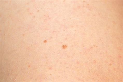 Tiny Red Blood Spots On Skin Pictures / Petechiae Causes Treatments Pictures And More : These ...