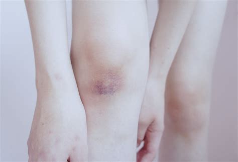 Bruises on my knees | i have something with bruises, my phot… | Flickr