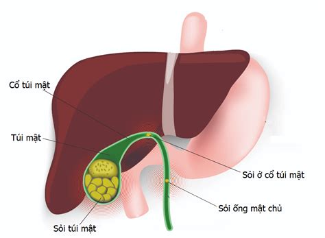 Stone stuck in bile duct | Vinmec