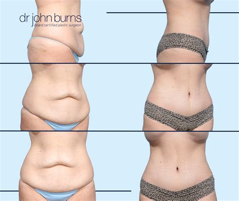 Dallas Tummy Tuck Before & After Results by Dr. John Burns – Dr John Burns