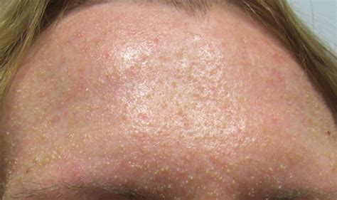 Follicular Hyperkeratosis Face