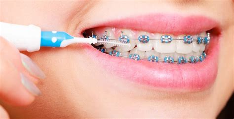 4 Tips For Brushing & Flossing With Braces - Nevada Dentistry & Braces