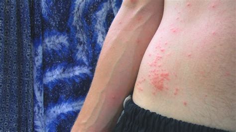 Mosquito Bites: Symptoms, Diseases, and Treatments