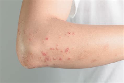 How Do Dust Mites Affect Your Skin? - Singapore Dermatologist