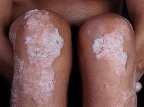 Psoriasis on black skin: Pictures, symptoms, and treatment