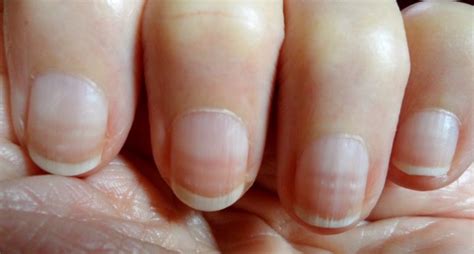 Nail Clubbing: Signs, Stages and Treatment – NailDesignCode