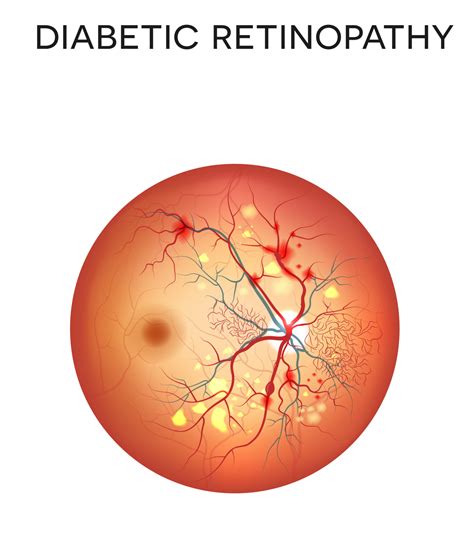 Diabetic Retinopathy - Retina Vitreous Consultants, Inc