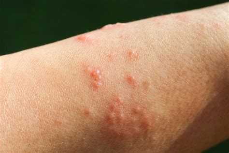 What Does Poison Ivy Rash Look Like? Symptoms to Know | SELF