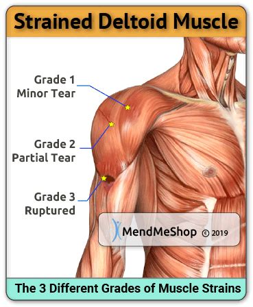 Deltoid Strain | Deltoids, Muscle strain, Muscle tear