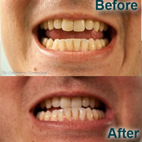 Smokers Teeth Before And After