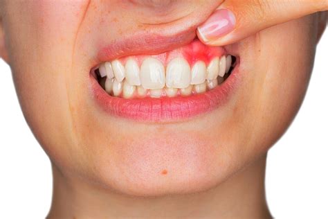 How To Treat Painful Gums at Travis Pinto blog