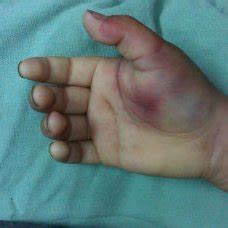 Clinical picture of metacarpophalangeal joint dislocation of thumb in... | Download Scientific ...