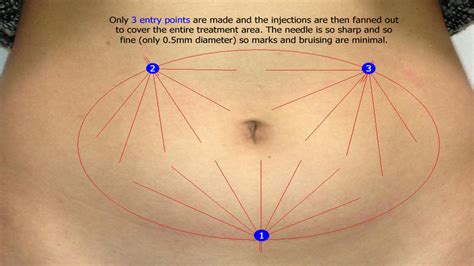 Stomach Aqualyx Fat Dissolving Injections Before and After