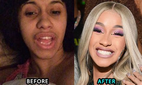 Cardi B Plastic Surgery New Teeth Boob Job Butt Injections Before | My ...