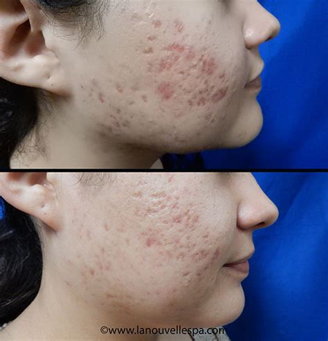 Laser Genesis Before and After Photos by Dr. Hanna | Ventura