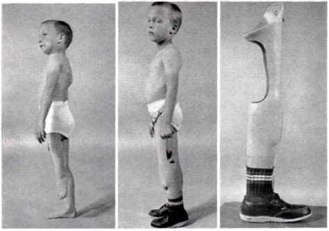 Fig. 10. Views of phocomelia of left lower ext | O&P Digital Resource Library