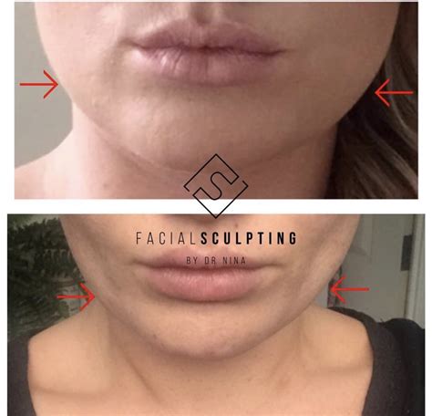 Jawline Slimming - Facial Sculpting