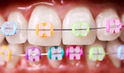 Orthodontics Rubber Bands Stock Photos Free Royalty-Free Stock Photos ...