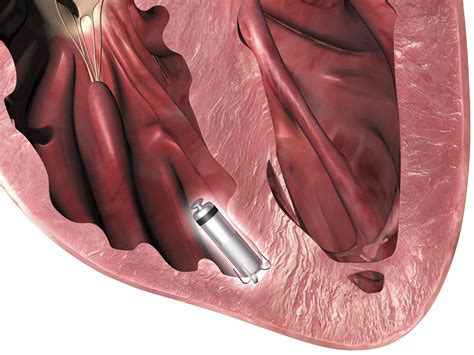 Leadless Pacemakers Associated With Fewer Complications - The ...